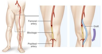 https://centrovascularyendovascular.com.mx/wp-content/uploads/2021/02/enfermedad-arterial-periferica-centro-vascular-400x212.jpg